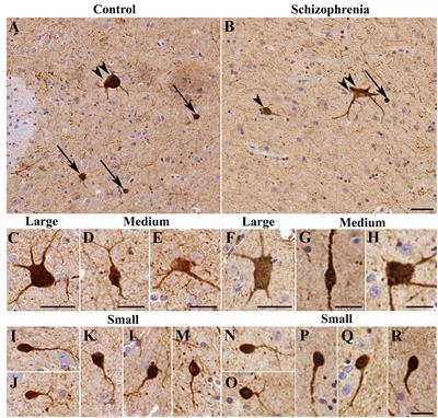 Evidence for Decreased Density of Calretinin-Immunopositive Neurons in the Caudate Nucleus in Patients With Schizophrenia